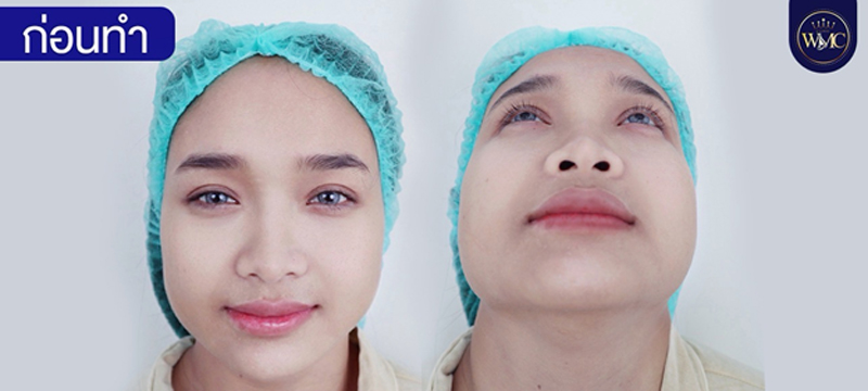 เสริมจมูก พัทยา ทรงมาดาม WMC Clinic