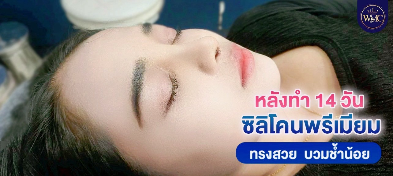 เสริมจมูก พัทยา ทรงมาดาม WMC Clinic