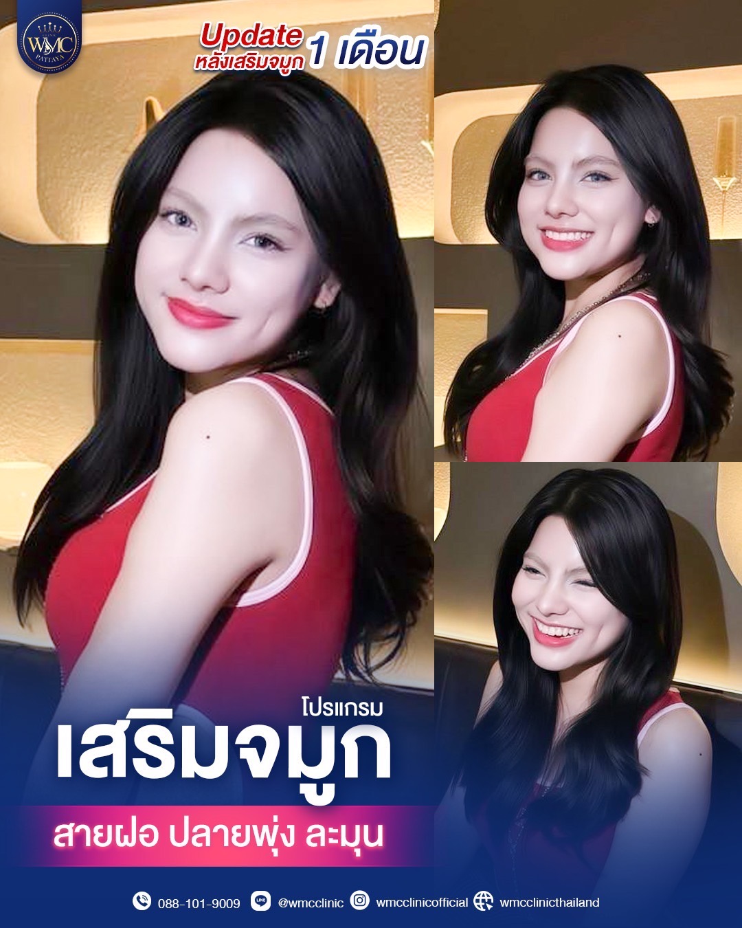 เสริมจมูก พัทยา ทรงมาดาม WMC Clinic