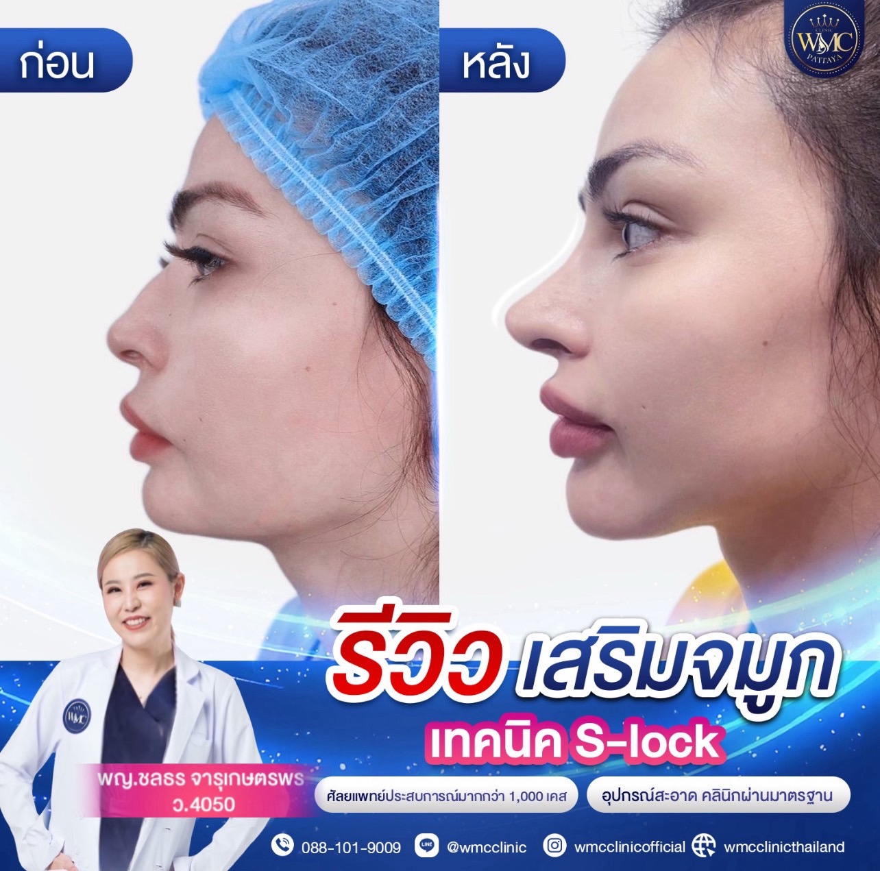 เสริมจมูก พัทยา ทรงมาดาม WMC Clinic