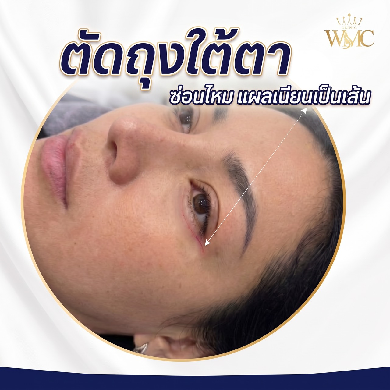 ตัดถุงใต้ตา